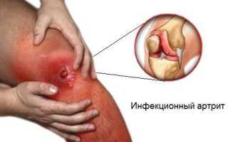 Хламидийный артрит: сопутствующая патология или причина?