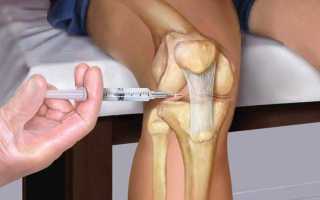 Эффективные физиопроцедуры в комплексном лечении артроза коленного сустава
