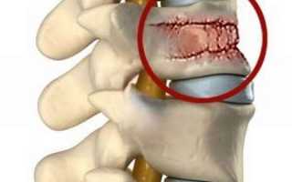 Причины разрушения костной ткани позвоночника