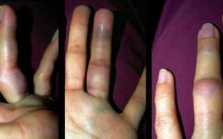 Что делать, если выбит палец на руке: практические советы