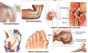 Хронический бурсит: симптомы и лечение опасного воспаления суставов