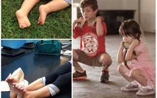 Комплекс упражнений для стоп при вальгусной деформации у ребенка