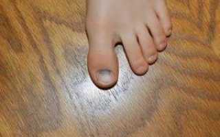 Черный палец на ноге при диабете фото