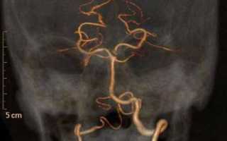 Гипоплазия левой/правой позвоночной артерии