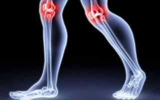 Вальгусная деформация коленных суставов: фото, причины, лечение
