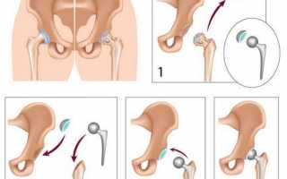 Операция по замене тазобедренного сустава — показания, виды эндопротезов