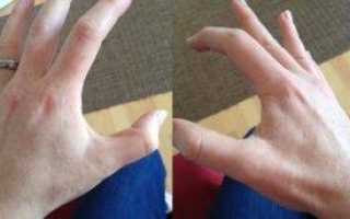 Почему дергается большой палец на руках. на руке дергается мышца: причины и лечение болезней, проявляющихся этим симптомом
