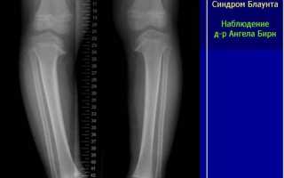 Признаки и причины вальгусной деформации коленных суставов у детей, ее лечение