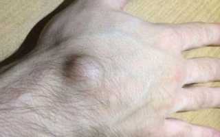 Гигрома: странная шишка на руке