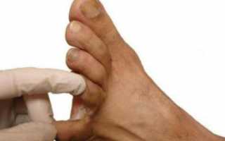 Как вылечить натоптыши и мозоли между пальцами ног?