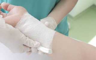 Гигрома на кисти руки: причины, симптомы, лечение кисты