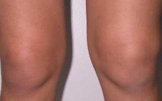 Опухло под коленом сзади: лечение в москве