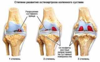 Причины, симптомы и лечение артроза коленного сустава