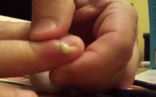 Болит палец под ногтем на руке чем лечить