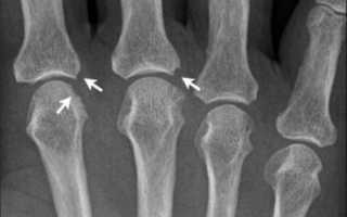 Артрит коленного сустава на рентгене