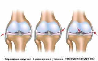 Закачать колено после травмы