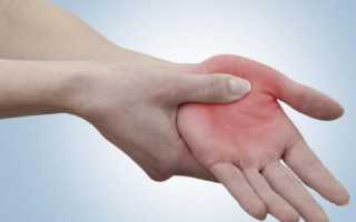 Как оказать первую помощь при переломе руки