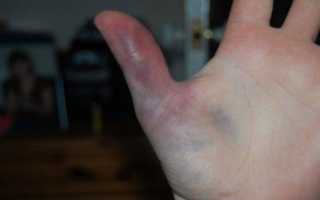 Боль в суставе большого пальца на руке: причины и лечение