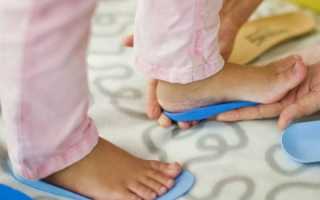 Ноги иксом у детей: причины появления, симптомы, фото, лечение, массаж и профилактика