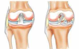 Какое лечение поможет при растяжении связок коленного сустава?