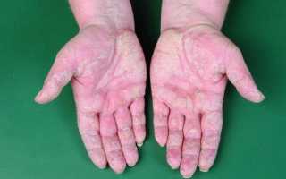 Опухают суставы пальцев рук: причины, как и чем лечить?