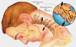 Причины хруста в шее при повороте головы. лечение хруста в шее
