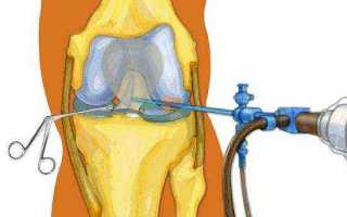 Артроскопия коленного сустава: особенности проведения и реабилитация