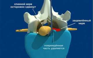 Эндоскопическая операция по удалению грыжи позвоночника: клиники москвы, цены и врач