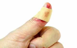 Как правильно бинтовать руку при переломе большого пальца