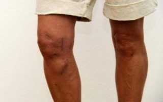 Строение коленного сустава человека, вальгусная и варусная деформация
