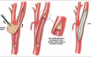 Атеросклероз артерий шеи симптомы