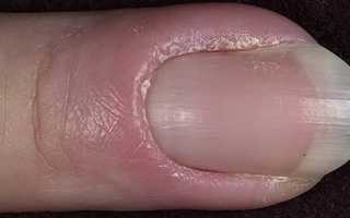 Панариций. причины, симптомы, лечение заболевания. панариций подногтевой, пальцев рук и ног