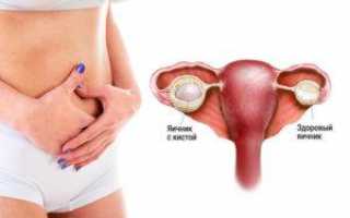 Почему болят яичники у женщин: причины, симптомы при различных состояниях, методы лечения