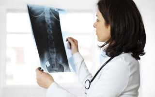 Лечение артрита плечевого сустава: лекарственные препараты и народные средства