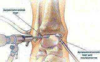 Дегенерация менисков коленного сустава лечение