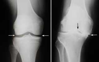 Осложнения и боли после эндопротезирования коленного сустава: список основных