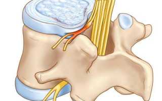 Протрузии грудного отдела позвоночника: симптомы, лечение и профилактика