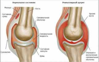 Что такое ревматоидный артрит коленного сустава?