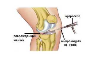 Мениск коленного сустава