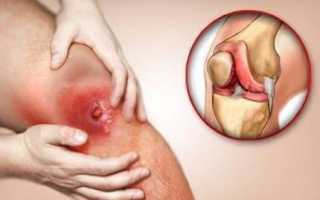 Инфекционный артрит: симптомы, диагностика и методы лечения