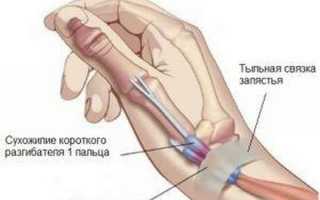 Воспаление сухожилия большого пальца руки лечение