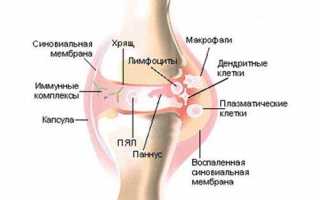Cиновит коленного сустава