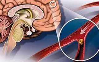 Проблема нарушения мозгового кровообращения при шейном остеохондрозе