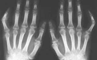Факторы риска развития остеопороза кистей рук и меры профилактики