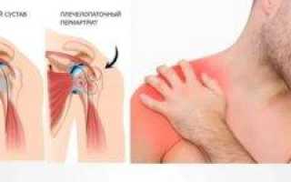 Синовиальная жидкость в плечевом суставе лечение