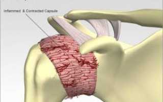 Адгезивный капсулит плечевого сустава: симптомы, диагностика и лечение