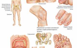 Симптомы и лечение реактивного полиартрита суставов