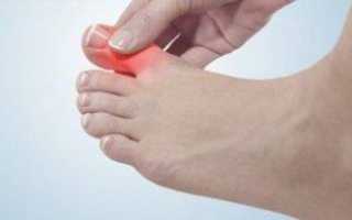 Болят подушечки стопы ног: что делать и как лечить
