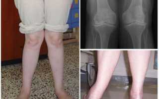 Вальгусное отклонение коленного сустава