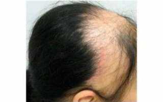 Выпадение волос от шейного остеохондроза